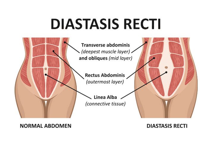 diagram of Diastasis Recti Singapore | Orchard Health Clinic