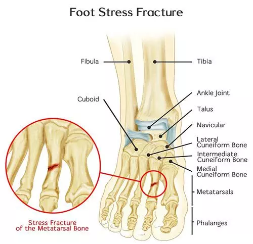 Foot Fracture | Orchard Health Clinic