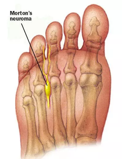 Morton's Neuroma | Orchard Health Clinic