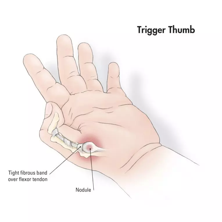 Trigger Thumb | Orchard Health Clinic