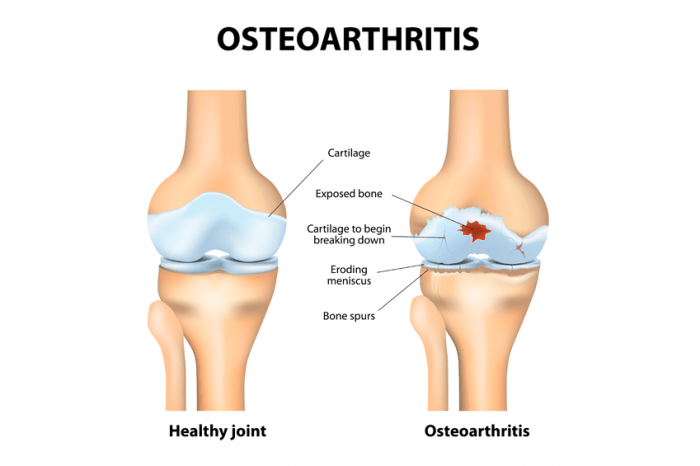 Image of Osteoarthritis | Orchard Health Clinic