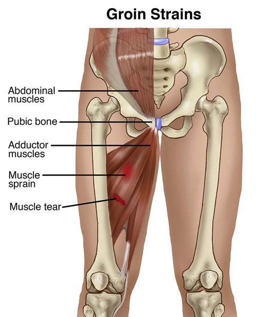 Groin Strain Physiotherapy | Orchard Health Clinic