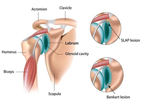 Shoulder Labrum Tears | Orchard Health Clinic