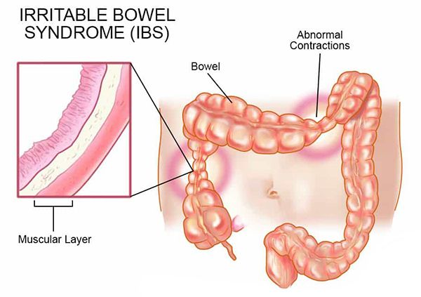 Irritable Bowel Syndrome | Orchard Health Clinic