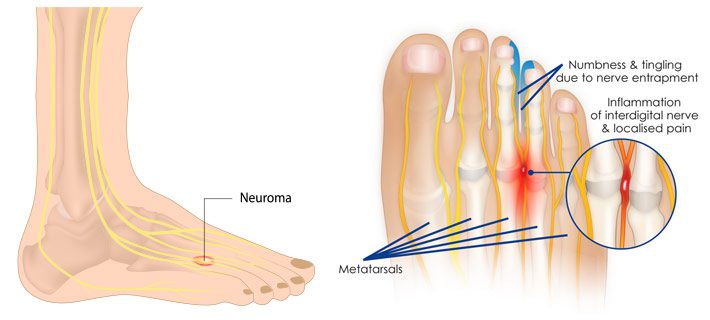 Metatarsalgia | Orchard Health Clinic