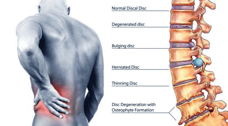 Diagram of Herniated-Disc | Orchard Health Clinic