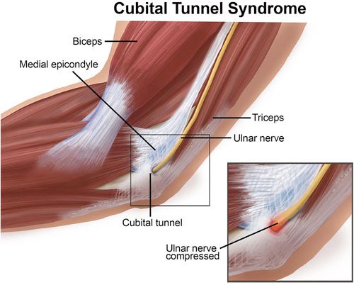 Image of Cubital Tunnel Syndrome | Orchard Health Clinic