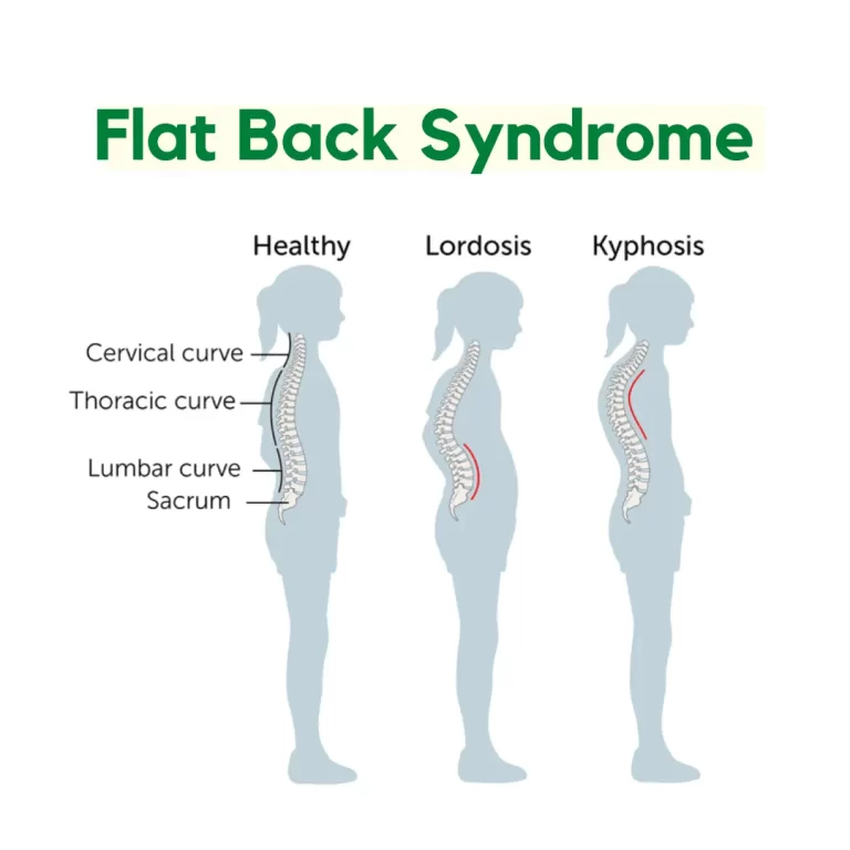 illustration of flat back syndrome | Orchard Health Clinic