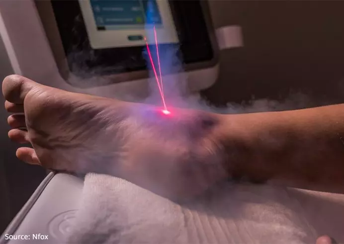 Cryotherapy | 4 Common Treatment Options For Plantar Fasciitis