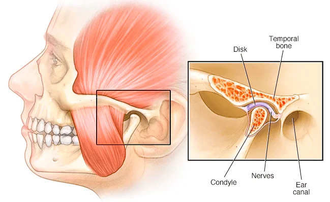 Jaw Pain (Temporomandibular Joint Dysfunction)